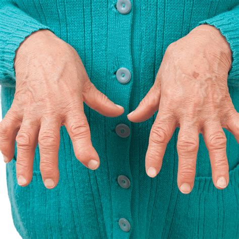 pulandit finger|How to Get Rid of Arthritis in the Fingers .